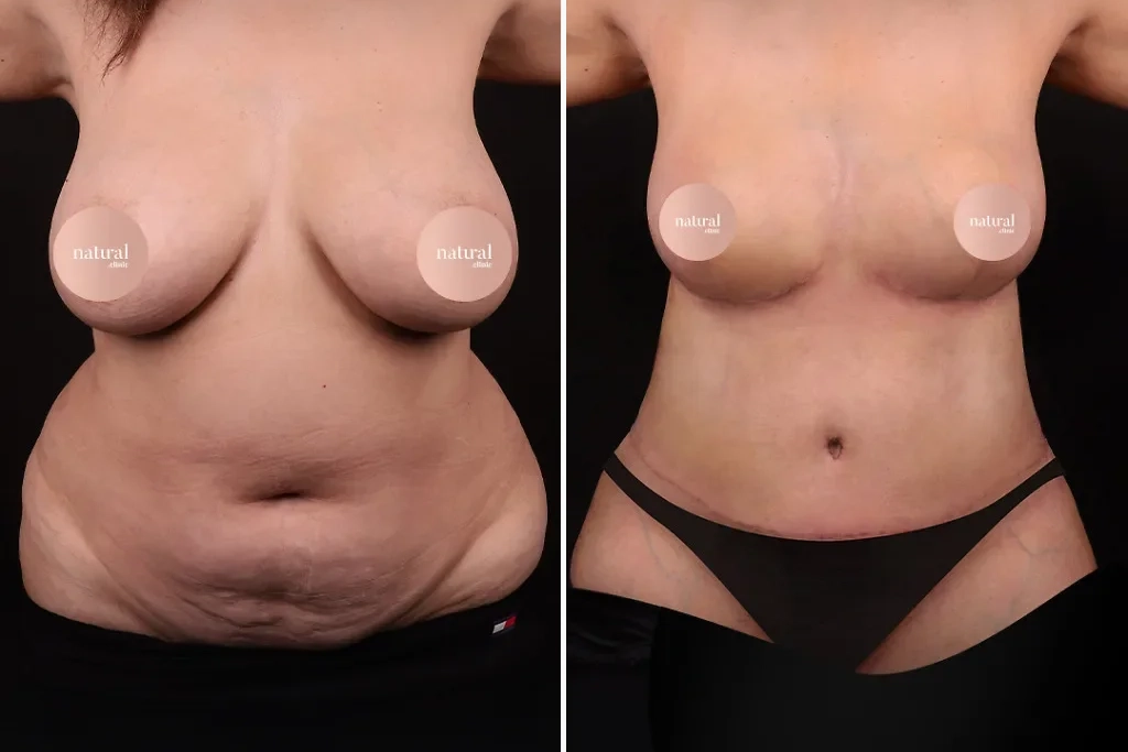 MommyMakeover4