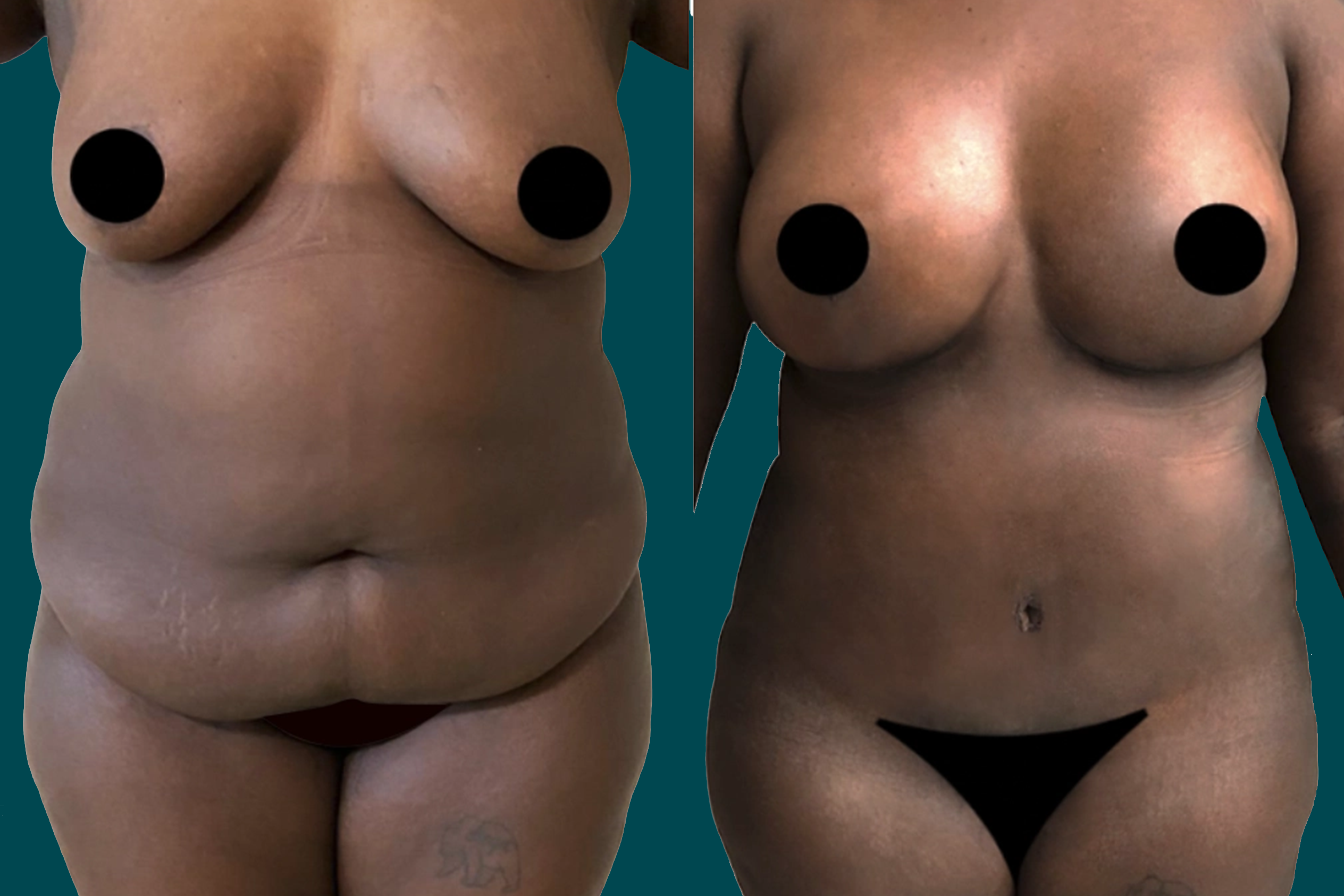 Mommy Makeover Before and After 5