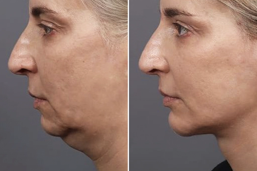 NeckLift2