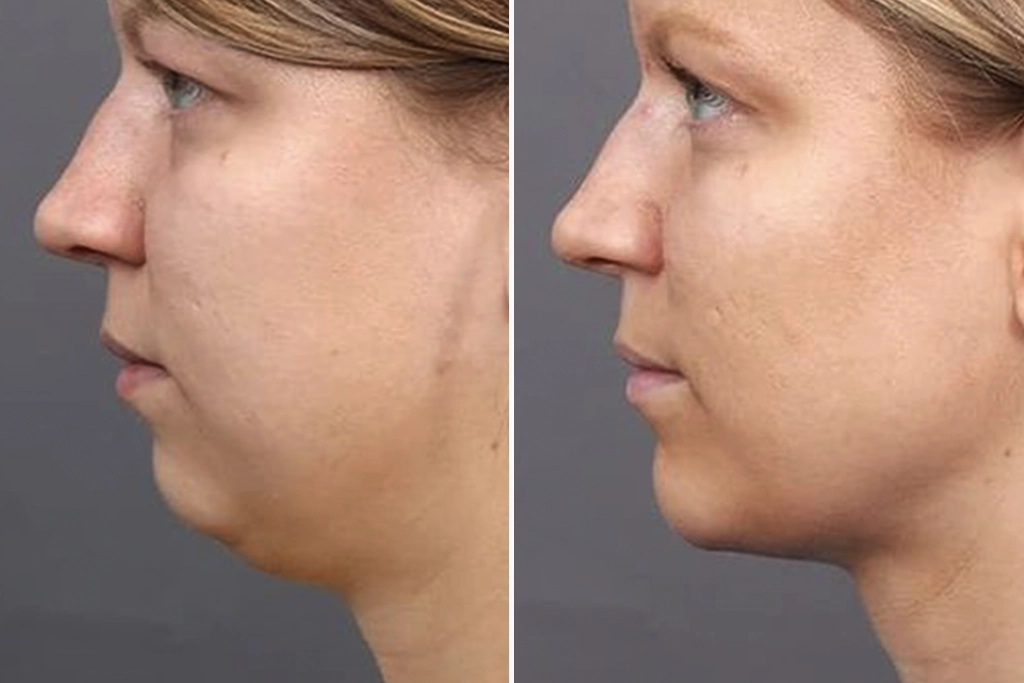 NeckLift3