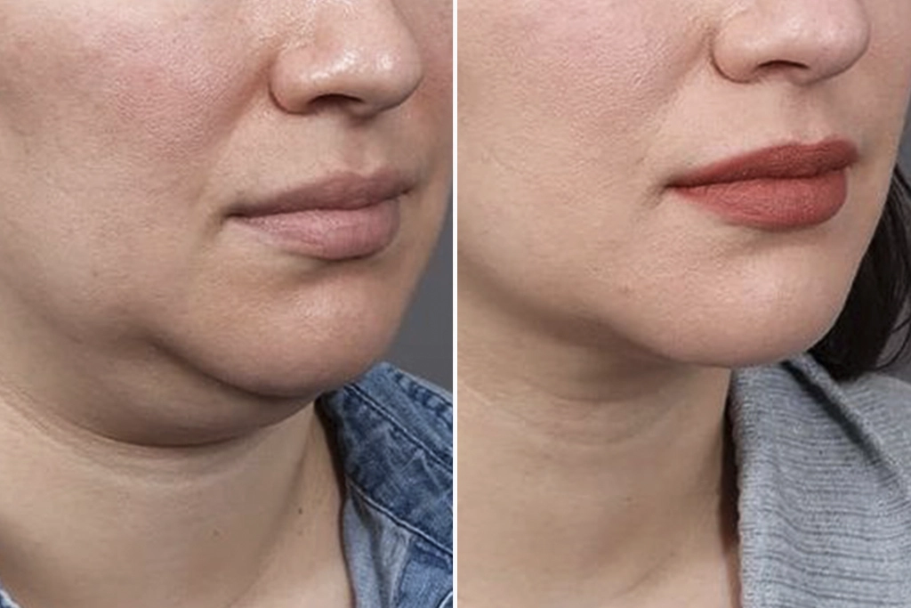 NeckLift4