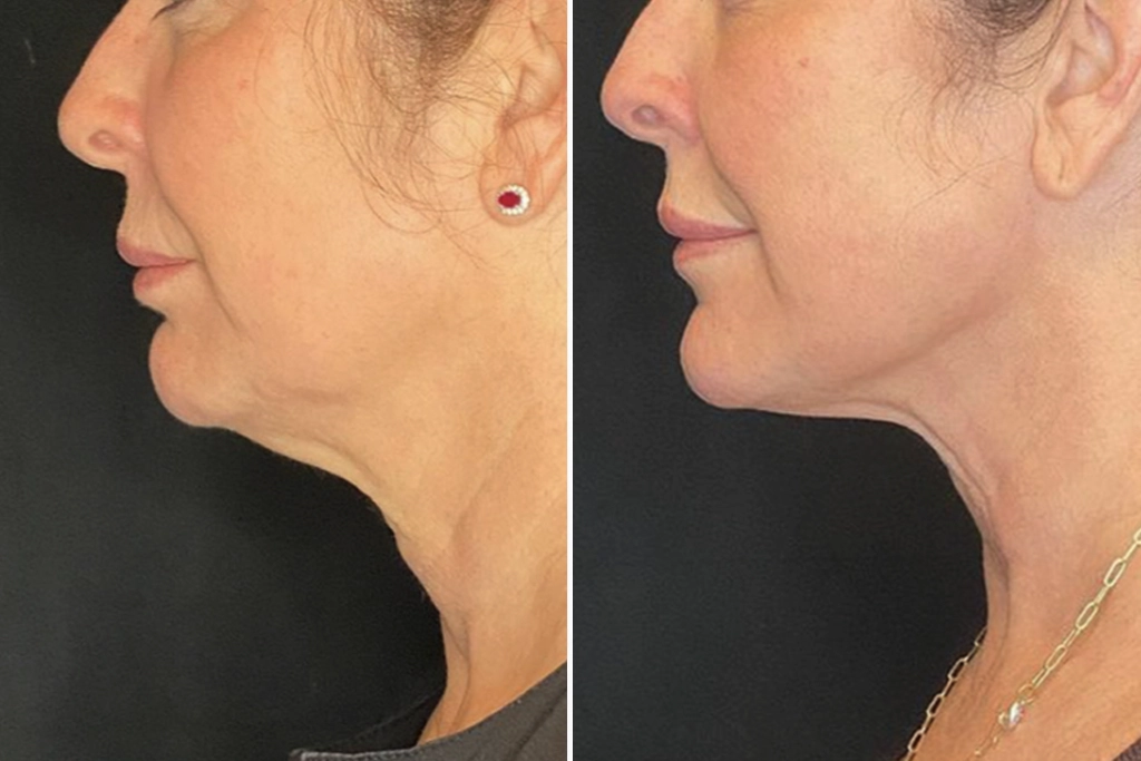 NeckLift5