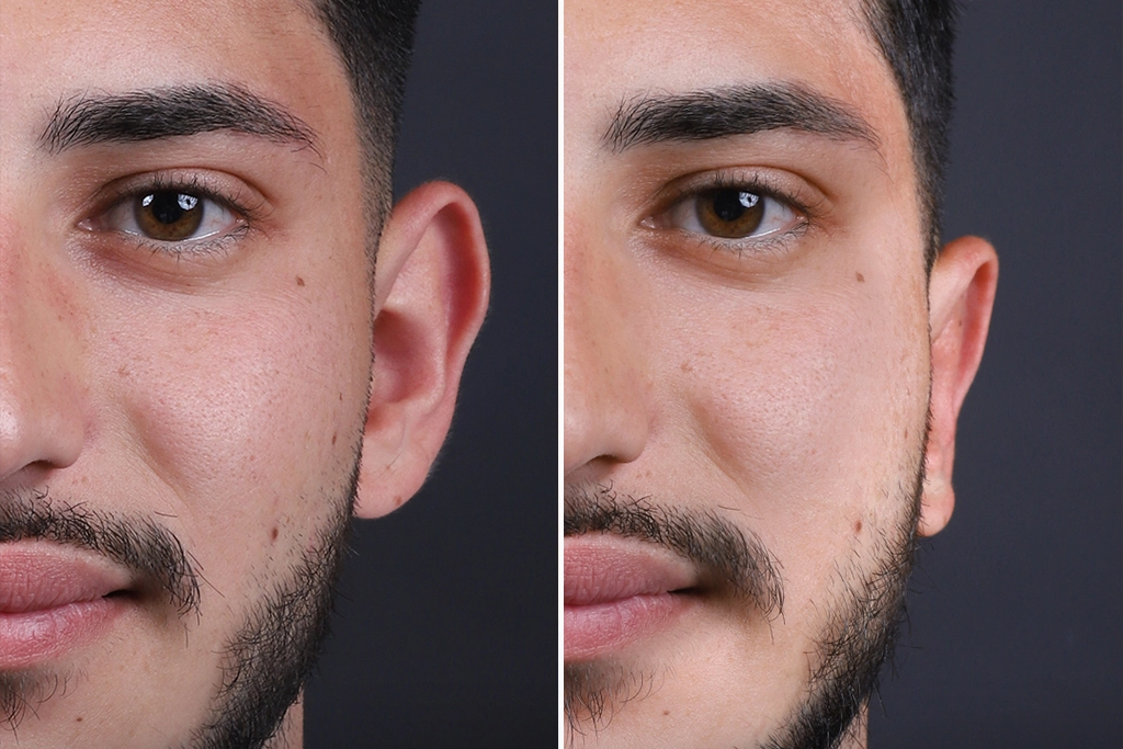 Otoplasty1