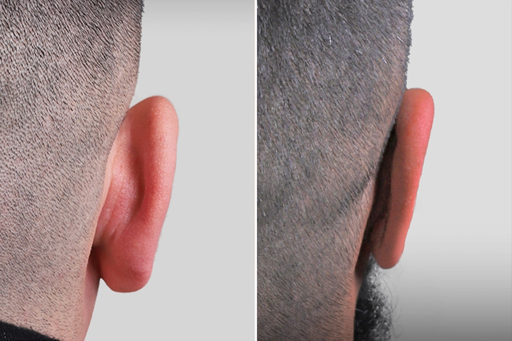 Otoplasty3