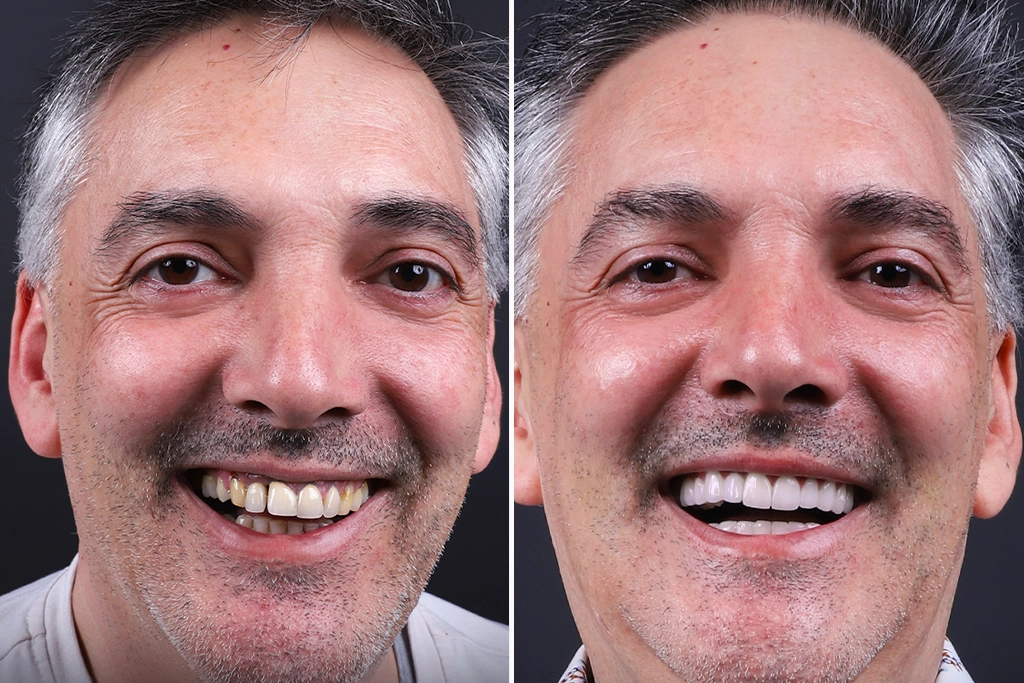 Dental-Crowns