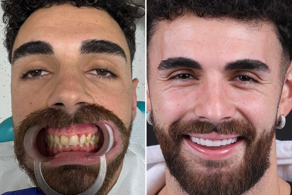 Dental-Crowns