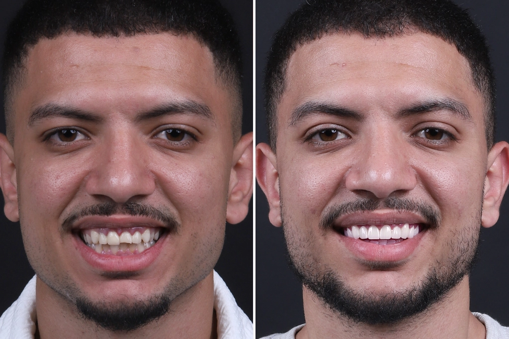 Dental-Crowns