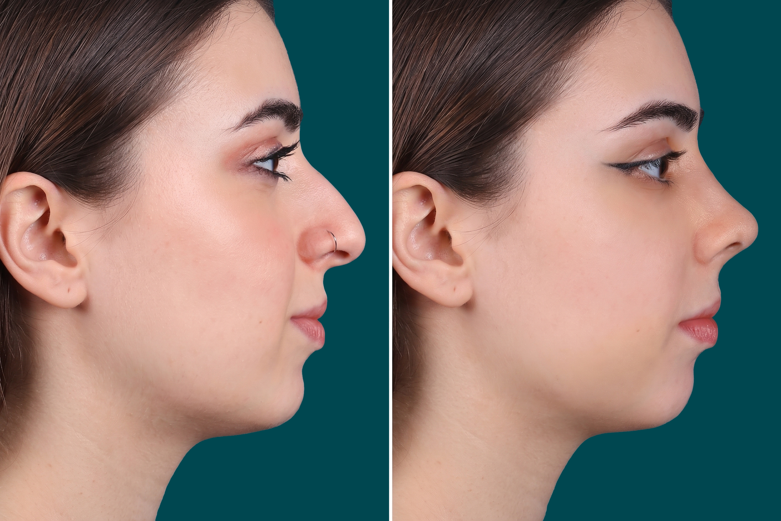 Rhinoplasty Before and After 2