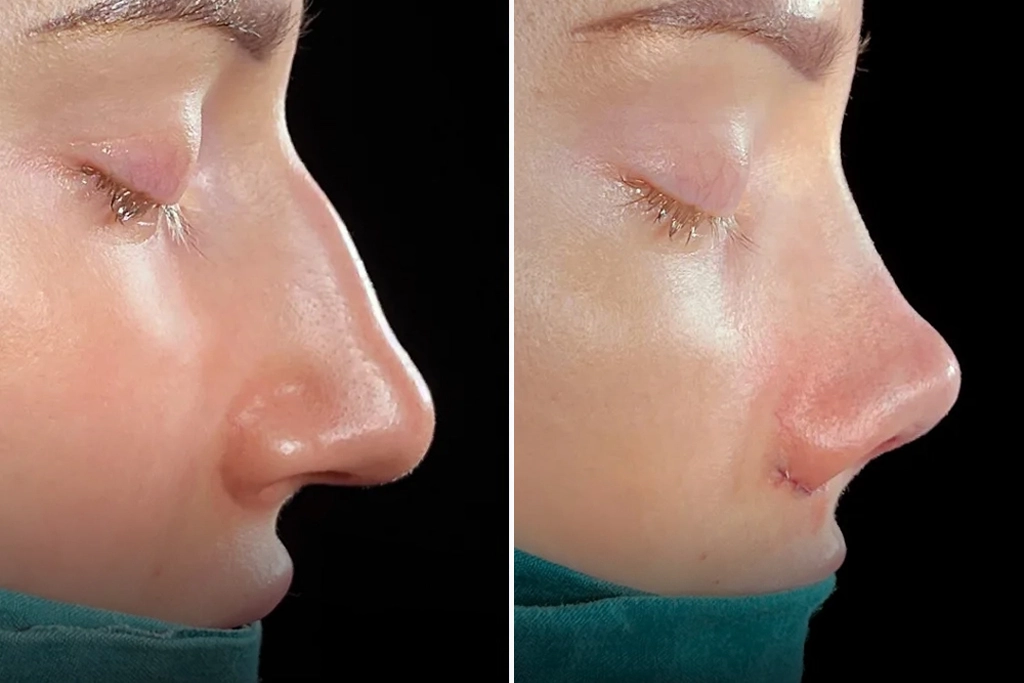 Rhinoplasty1