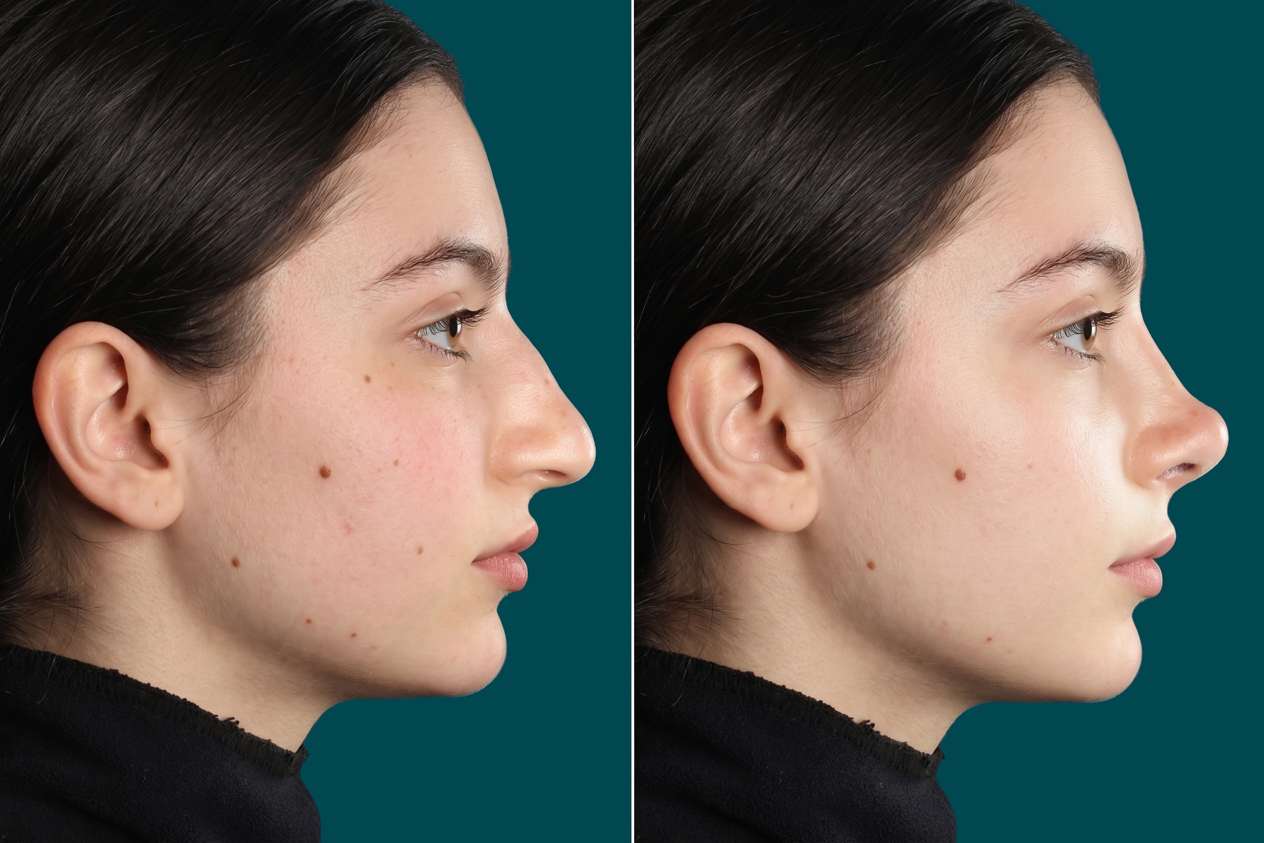 Rhinoplasty Before and After 11
