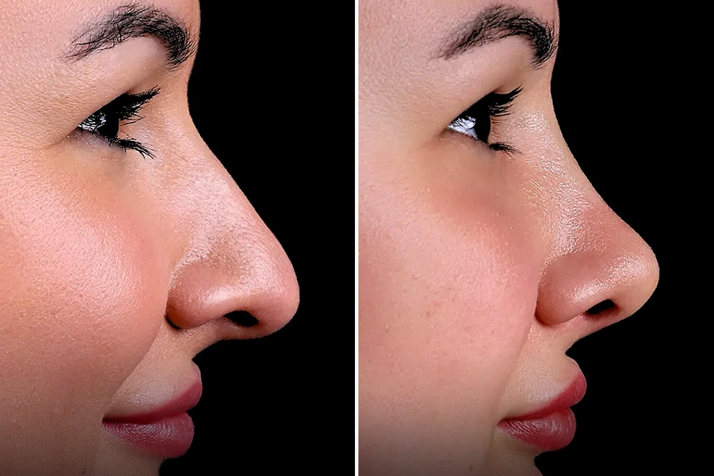 Rhinoplasty2