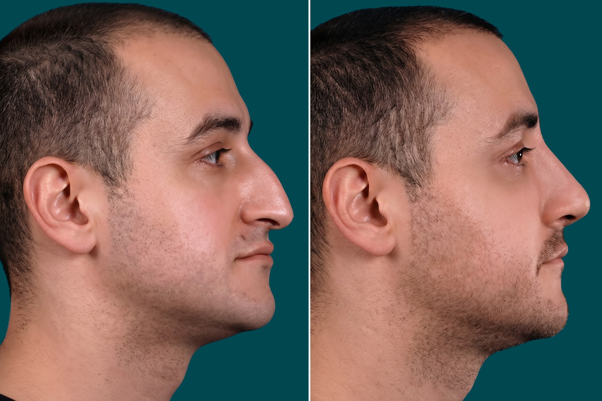 Rhinoplasty Before and After 3