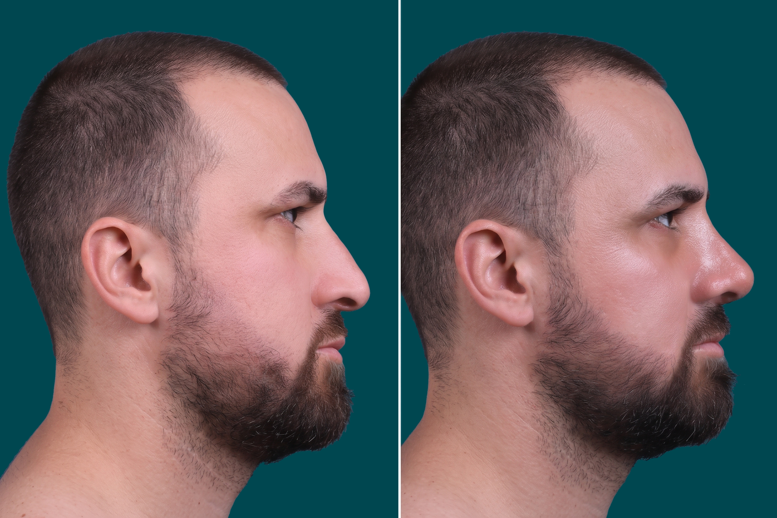 Rhinoplasty Before and After 7