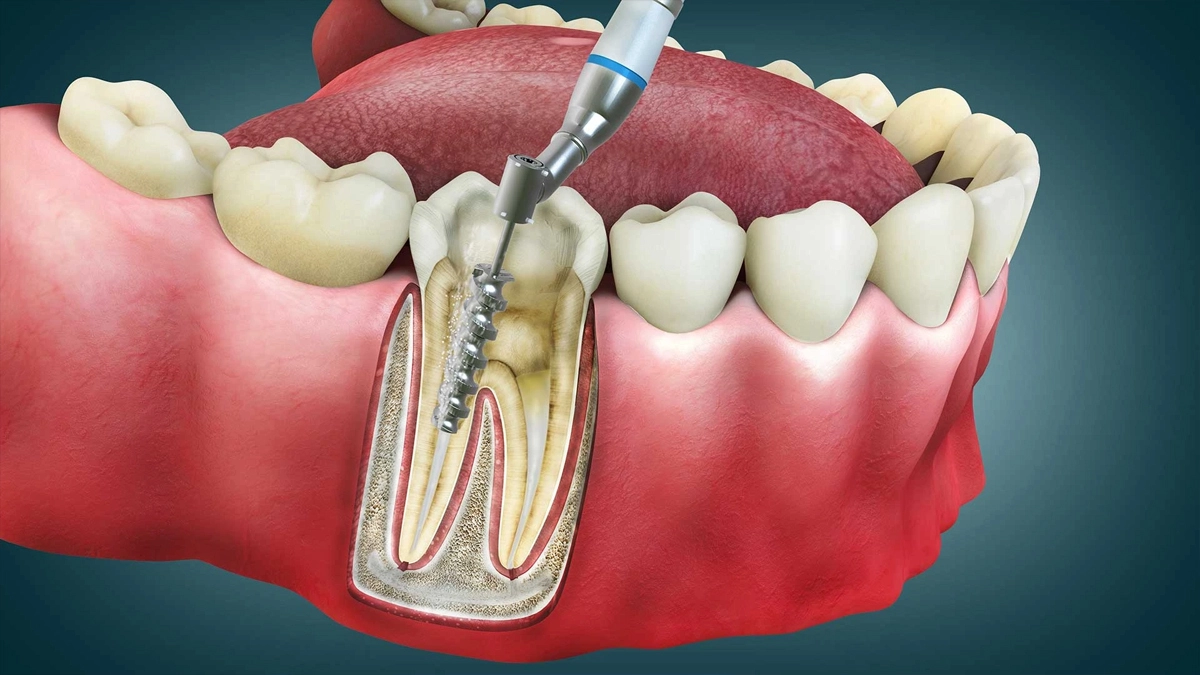 Root-Canal-Treatment
