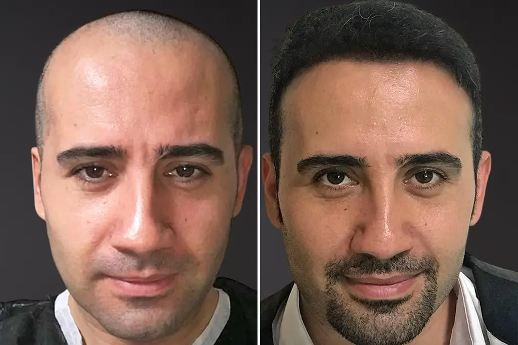 Sapphire FUE Hair Transplant