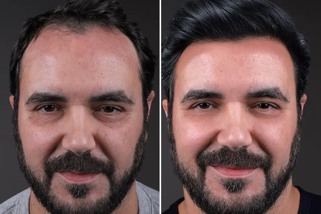 Sapphire FUE Hair Transplant