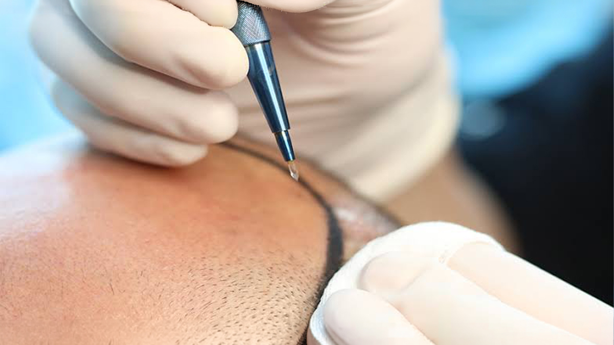 Sapphire FUE Hair Transplant