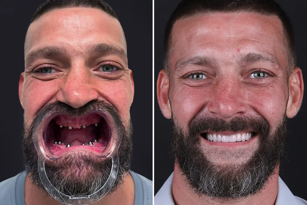 Smile-Makeover