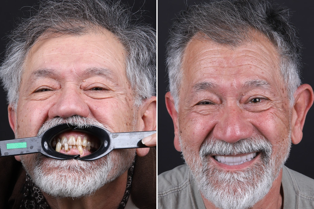 Smile-Makeover