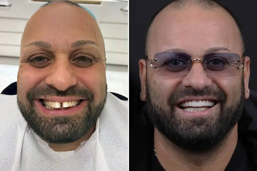 Smile-Makeover
