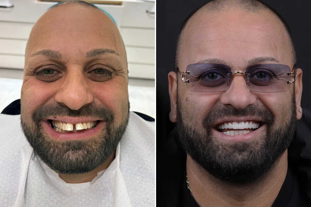 Smile-Makeover
