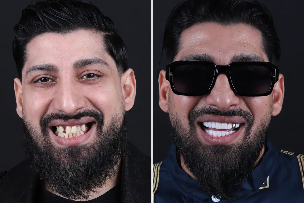 Smile-Makeover
