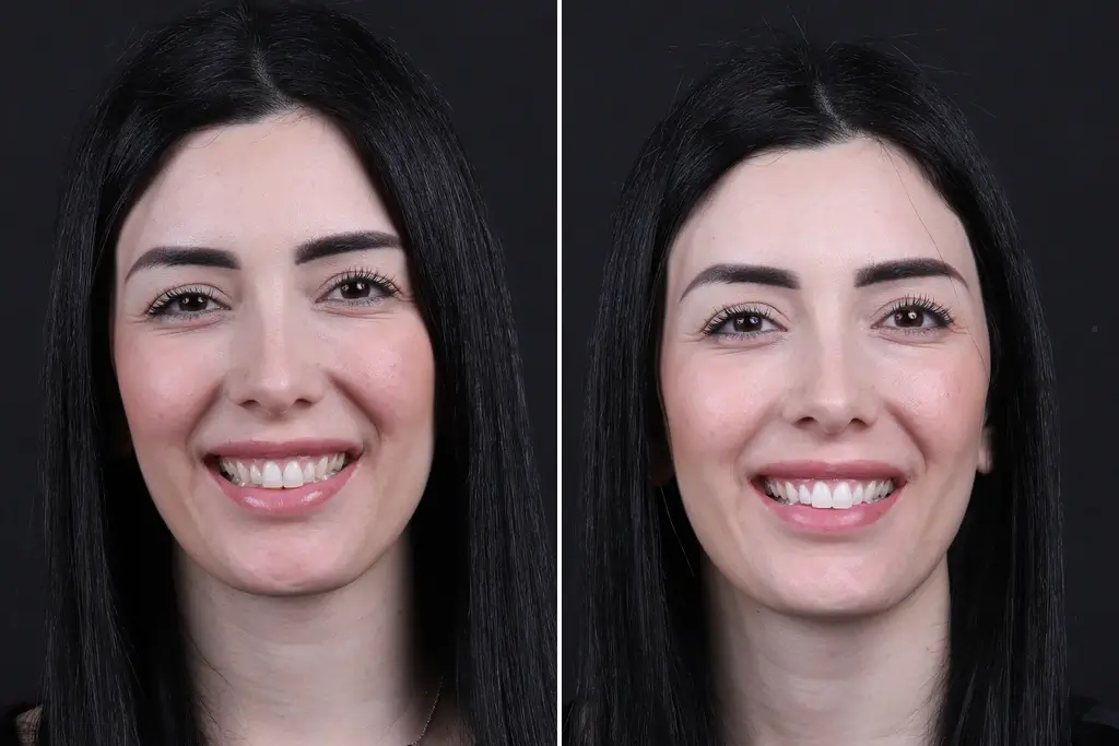 Teeth-Whitening 