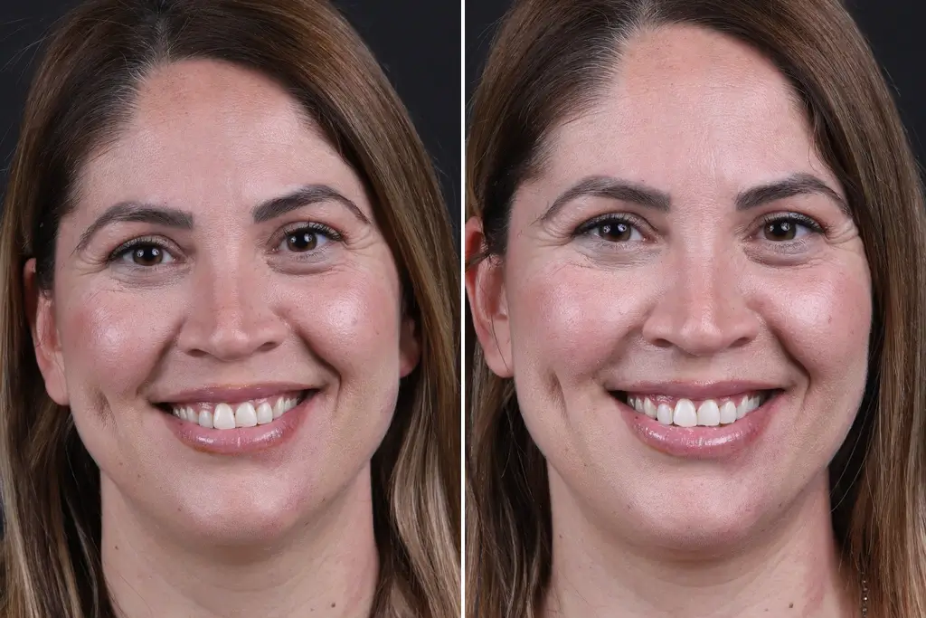 Teeth-Whitening 