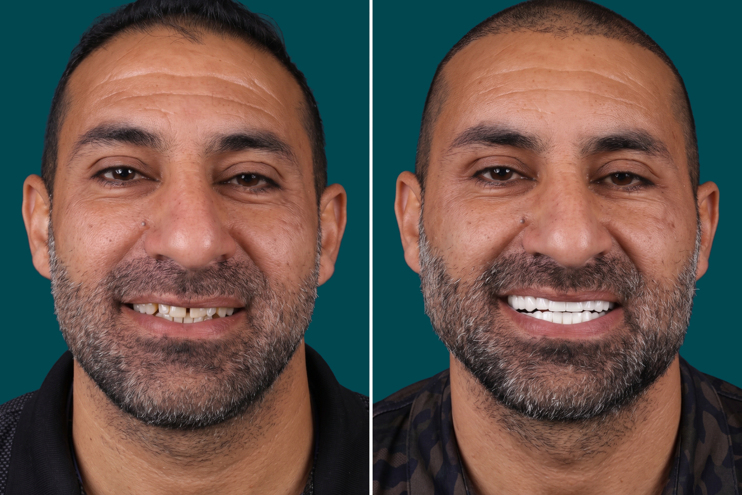 Teeth-Whitening 3
