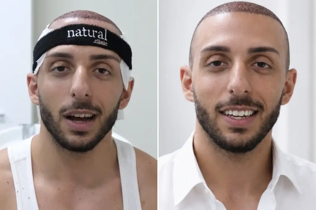 Teeth-Whitening 