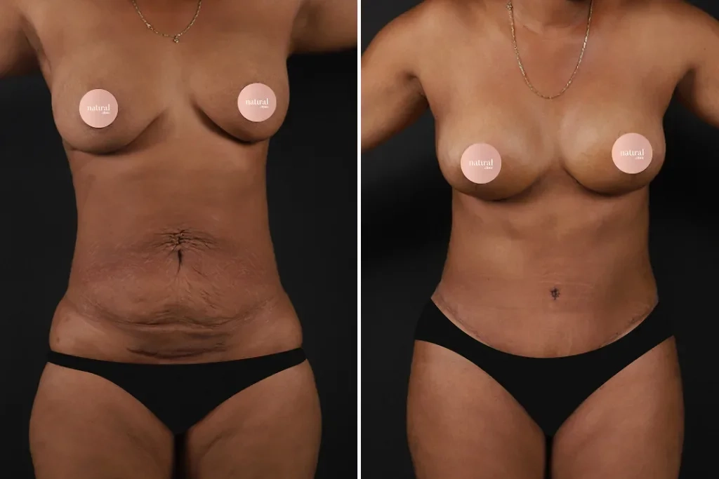 TummyTuck1