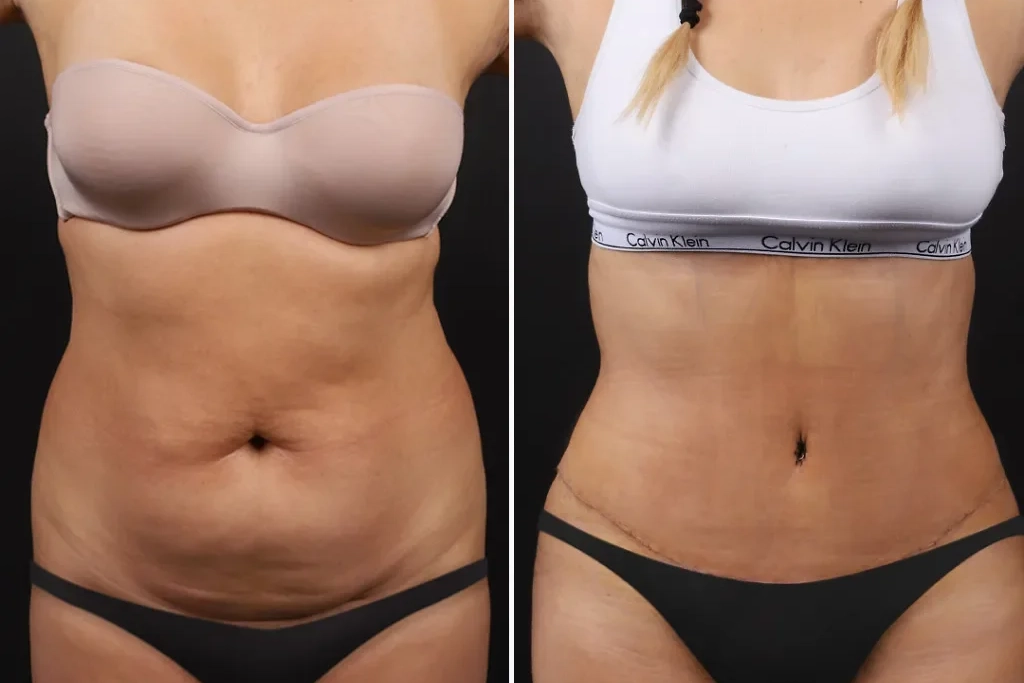TummyTuck2