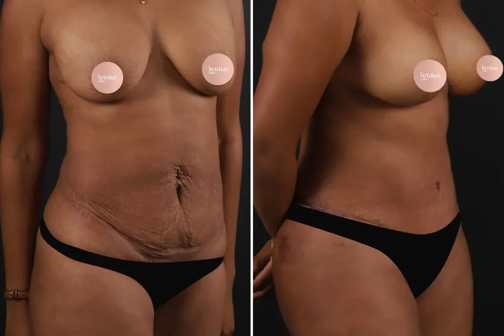 TummyTuck3