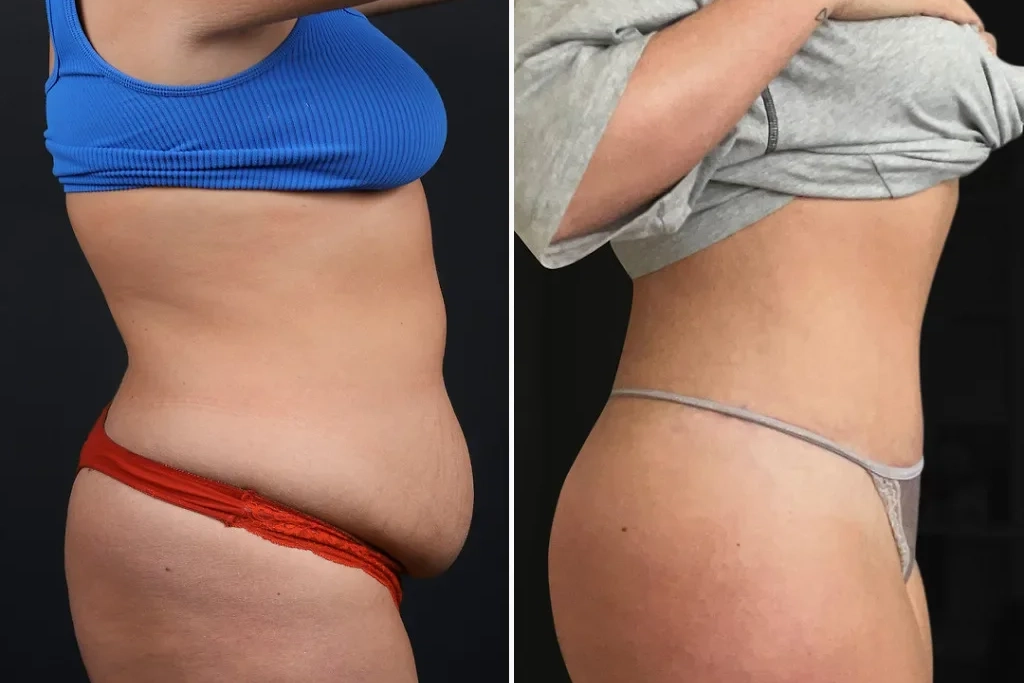 TummyTuck4