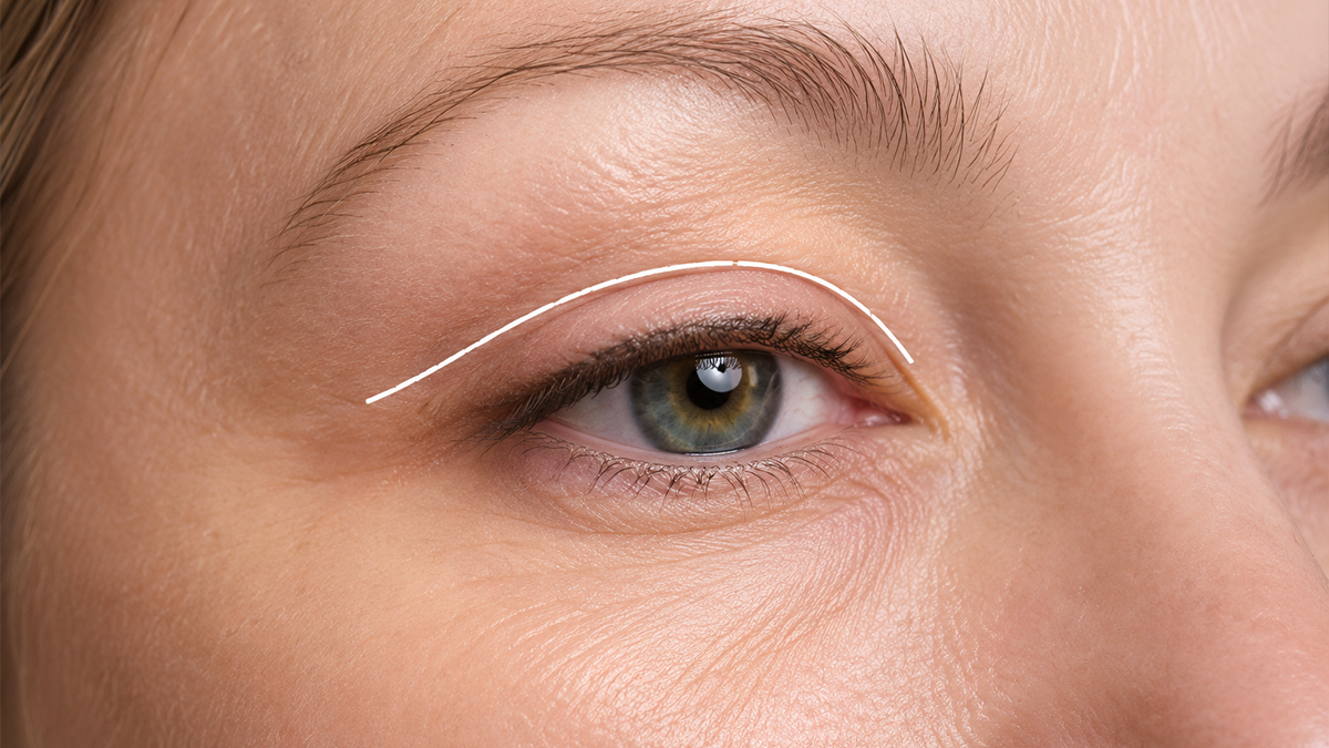 Upper Blepharoplasty in Turkey