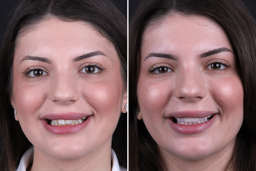 Dental-Crowns