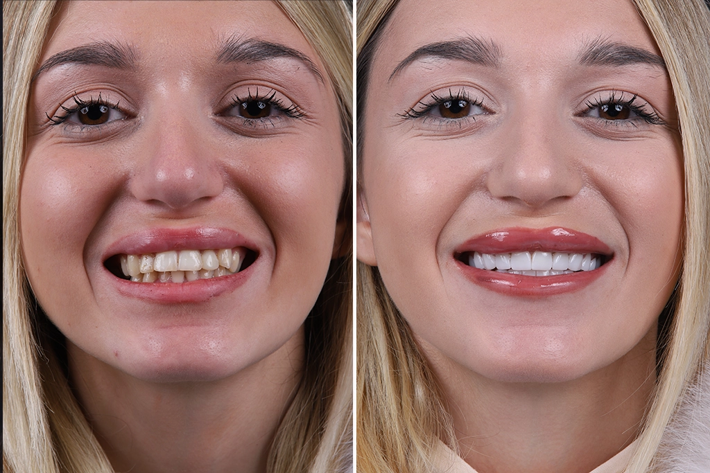 Dental-Crowns