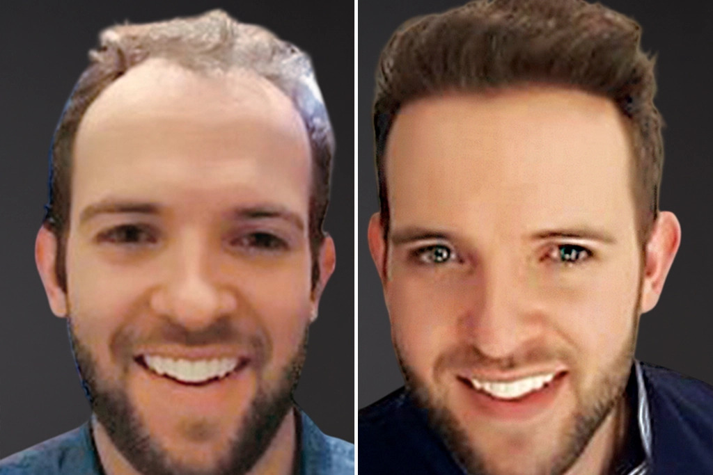 fue hair transplant