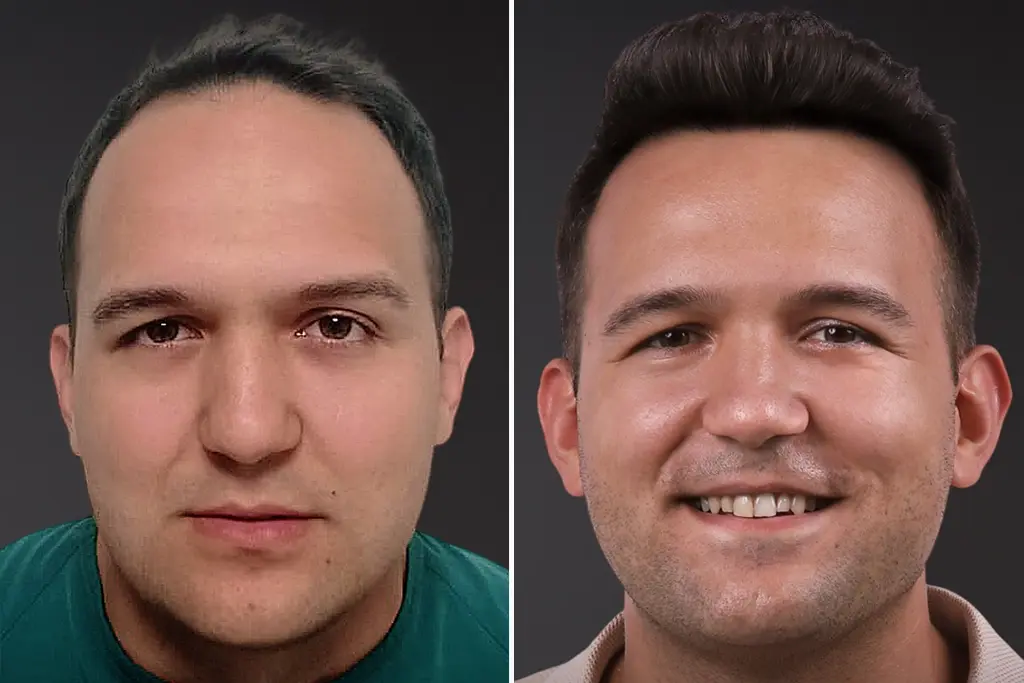 fue hair transplant
