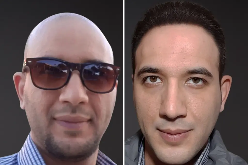 fue hair transplant