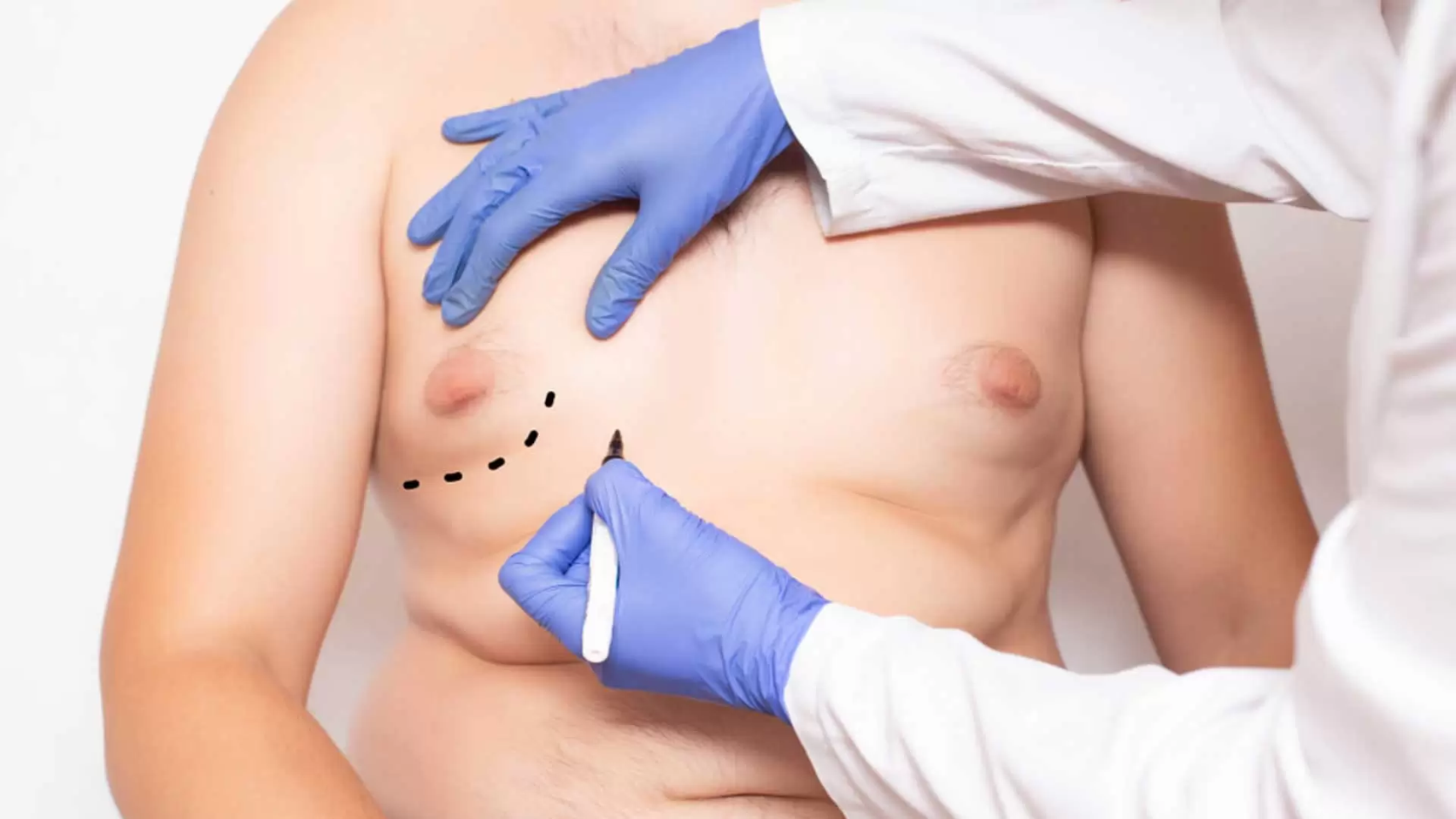 gynecomastia why turkey